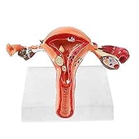 Female Uterus with Ovary Pathological Anatomical Model | Diseased 3D Anatomy of Human Reproductive (System Perfect for Medical Students and Training)