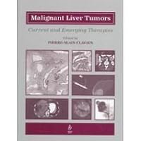 Malignant Liver Tumors Malignant Liver Tumors Hardcover
