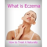 What Is Eczema and How to Treat it Naturally