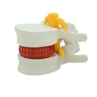 Enlarged Lumbar Spine Model of Human Body, Simulating Intervertebral Disc Herniation, Teaching and Medical Use, 4.52×4.13×3.34in
