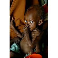 Malnourished child in a clinic during the famine in 2008 Nigeria Poster Print by VWPicsStocktrek Images (11 x 17)