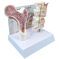 Teaching Model,Human Femoral Osteoporosis Anatomical Model, Medicine Anatomical Health and Pathological Comparison for Classroom Demonstration
