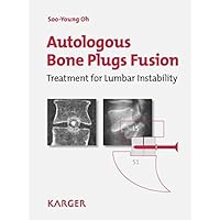 Autologous Bone Plugs Fusion: Treatment for Lumbar Instability: 3E Criteria/ Technical Operative Notes/ The Functioning of the Oh's Screw Autologous Bone Plugs Fusion: Treatment for Lumbar Instability: 3E Criteria/ Technical Operative Notes/ The Functioning of the Oh's Screw Hardcover