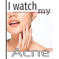 I watch my acne: Moderate your acne on a daily basis, with follow-ups on symptoms, diet, treatments, pain intensity, etc... 8X10, 101 pages