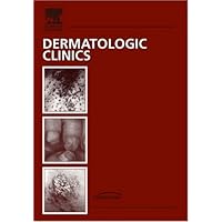Update on HIV/AIDS, An Issue of Dermatologic Clinics (Volume 24-4) (The Clinics: Dermatology, Volume 24-4)