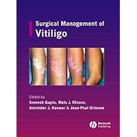 Surgical Management of Vitiligo Surgical Management of Vitiligo Kindle Hardcover