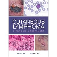 Cutaneous Lymphoma: Diagnosis and Treatment Cutaneous Lymphoma: Diagnosis and Treatment Hardcover Kindle