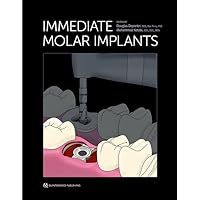 Immediate Molar Implants Immediate Molar Implants Hardcover Kindle
