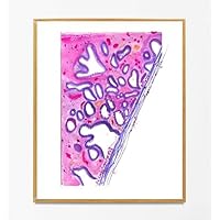Cervical Cancer Watercolor Histology Art, HPV Associated Adenocarcinoma, Gynecologic Pathology Office Decor, Fine Art Print (5x7 in)