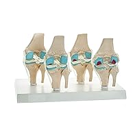 4 Stage Osteoarthritis Anatomical Knee Model, Model On Base, with Detailed Study