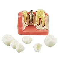 Dental Implant Study Analysis Crown Bridge Demonstration Teeth Model
