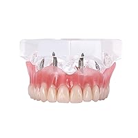 Dental Upper Implants Model Overdenture with 4 Superior Teeth Demo Transparent Vision for Education and Study Model Tool M6001 C