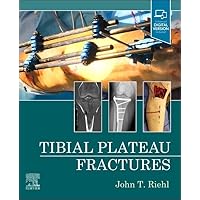 Tibial Plateau Fractures Tibial Plateau Fractures Hardcover Kindle