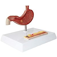 Stomach Pathologic Peptic Ulcer Human Digestive System Organ Anatomical Model 1/2 Life Size, for Teaching Demonstration, Medical Experiment Stomach