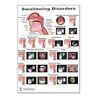 Swallow Disorders Anatomy Poster 12x17inch, Dysphagia Endoscopic View-oral Phase Disorders-nasal Regurgitation