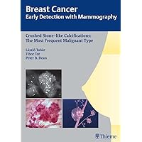 Breast Cancer: Early Detection with Mammography: Crushed Stone-like Calcifications: The Most Frequent Malignant Type (Tabar Mammo) Breast Cancer: Early Detection with Mammography: Crushed Stone-like Calcifications: The Most Frequent Malignant Type (Tabar Mammo) Kindle Hardcover Plastic Comb