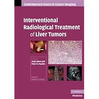 Interventional Radiological Treatment of Liver Tumors (Contemporary Issues in Cancer Imaging) Interventional Radiological Treatment of Liver Tumors (Contemporary Issues in Cancer Imaging) Kindle Hardcover