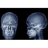 Laminated Human Skull X ray Image Front and Side Lateral View Skeleton Anatomy Medical Photo Poster Dry Erase Sign 16x24