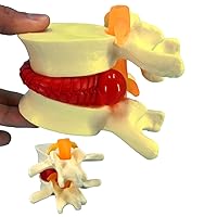 Human Anatomical Lumbar Disc Herniation Model, 1.5 Times Life Size Lumbar Disc Herniation Model, Human Lumbar Disc Herniation Model for Teaching, Learning, Demonstrating