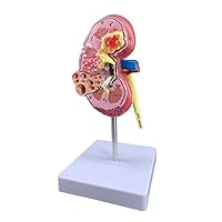 Anatomical Double-Sided Pathological Kidney Urinary System 1:1 Diseased Kidney Model & Normal Renal Functio