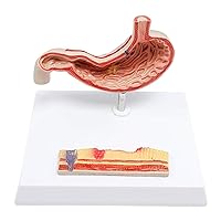 Anatomy Model Gastric Ulcer Anatomy - Stomach Anatomy - Medical Anatomical Stomach Diseased Model Human Organ - for Medical Study Teaching