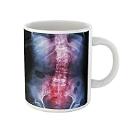Coffee Mug Spondylosis and Scoliosis Film X Ray Lumbar Sacrum Spine 11 Oz Ceramic Tea Cup Mugs Best Gift Or Souvenir For Family Friends Coworkers
