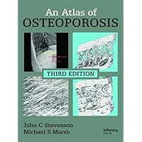 An Atlas of Osteoporosis (Encyclopedia of Visual Medicine Series) An Atlas of Osteoporosis (Encyclopedia of Visual Medicine Series) Hardcover Kindle Paperback
