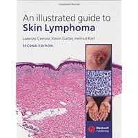 An Illustrated Guide to Skin Lymphoma An Illustrated Guide to Skin Lymphoma Kindle Hardcover