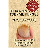 The Truth About Toenail Fungus - Onychomycosis