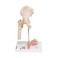 3B Scientific A88 Femoral Fracture and Hip Osteoarthritis - 3B Smart Anatomy