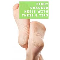 Fight Cracked Heels With These 8 Tips