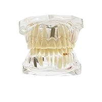 Dental Teeth Model,Transparent Dental Implant Teeth Model Dentist Standard Disease Removable Tooth Pathological Teaching Model (D-model)