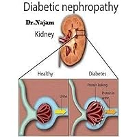 Pathogenesis, Clinical Manifestations, and Natural History of Diabetic Kidney Disease