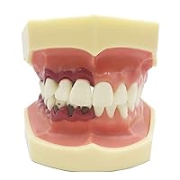 Periodontal Dental Teeth Model Disease Assort Teeth Gums Tooth Care Teaching Study Standard Typodont Model