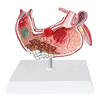 Human Stomach Model Digestive System Model Gastric Ulcer Model, Scientific Stomach Model, Teaching Medical Explanation
