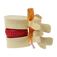 Anatomical Spine Lumbar Disc Herniation Anatomy Teaching School Supplies Props Free Postage Anatomical Teaching Models Designing Instruction for 21st Century Learners