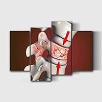 UJOYAFZSIM Orthopedic Human Anatomy Medical Poster Spinal fracture traumatic vertebral injury Wall Art Decor for Doctor Office Clinic Gift for Nurse Physicians Assistant Physical Therapist