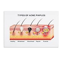 HARRET Beauty Salon Poster Acne Type Poster Skin Knowledge Poster (3) Wall Poster Art Canvas Printing Poster Office Bedroom Aesthetic Poster Unframe-style 18x12inch(45x30cm)