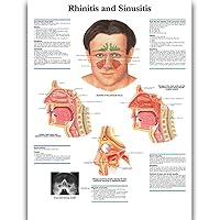 Rhinitis and Sinusitis Science Anatomy Posters for Walls Medical Nursing Students Educational Anatomical Poster Chart Medicine Disease Map for Doctor Medical Enthusiasts Kid's Enlightenment Education Waterproof Canvas