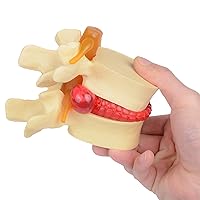 Human Anatomical Lumbar Disc Herniation Model 1:1.5Size Teaching Model Human Spine Model Yellow Color