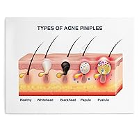 Beauty Salon Poster Acne Acne Epidermis Dermis Structure Poster Canvas Poster Wall Art Decor Print Picture Paintings for Living Room Bedroom Decoration Unframe-style 16x12inch40x30cm)