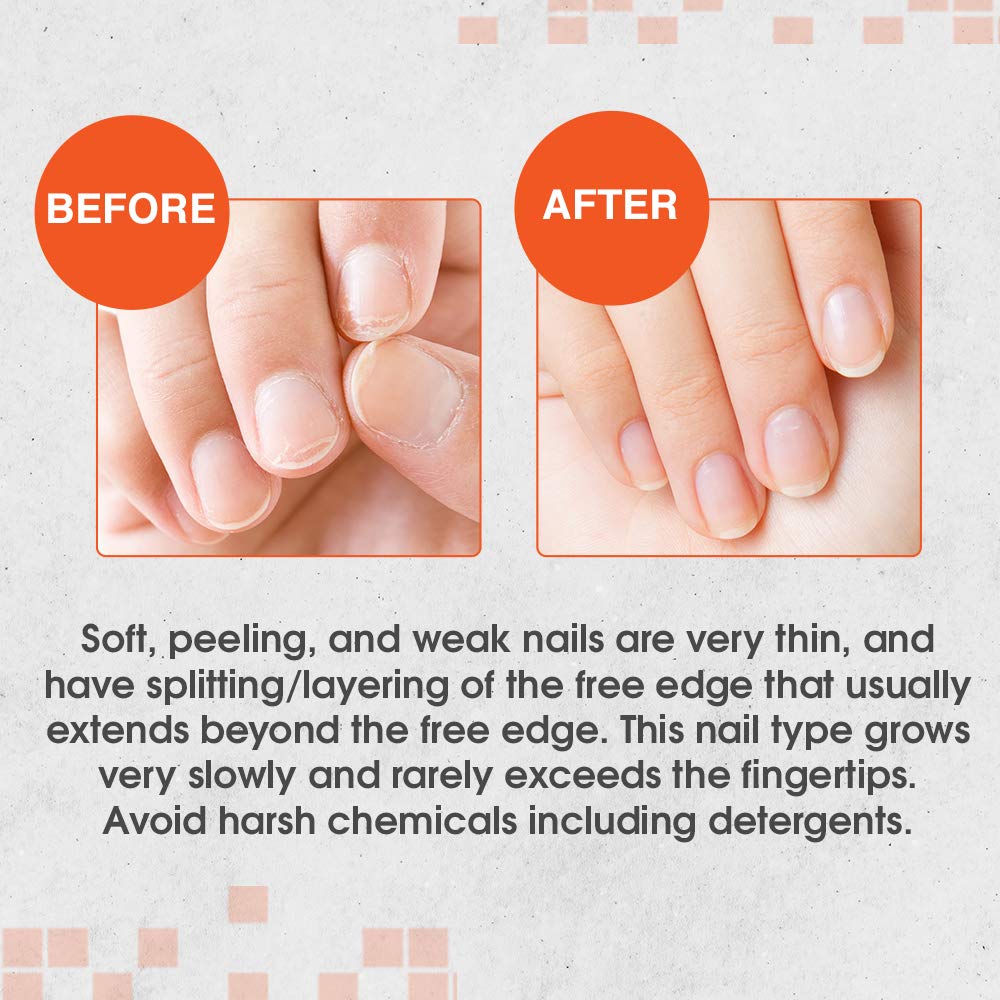 Brittle and peeling nails? Tips to strengthen them | Health News, Times Now