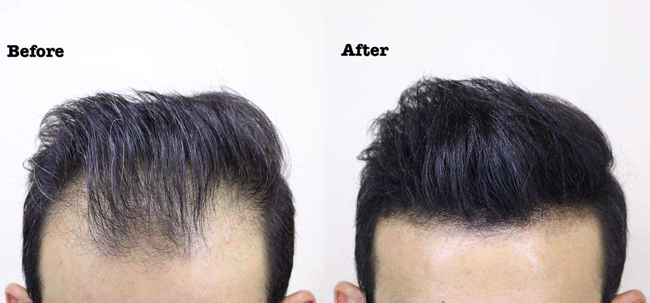 Mua THICK FIBER Hair Building Fibers for Thinning Hair & Bald Spots (BLACK)  - 25g Bottle - Conceals Hair Loss in Seconds - Hair Fibers for Men & Women  trên Amazon Mỹ