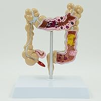 Large Intestine Pathological Model, Intestinal Disease Colon Lesion Anatomy Model, Medical Educational Demonstration Tool