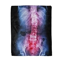 50x60 Inches Flannel Throw Blanket Spondylosis and Scoliosis Film X Ray Lumbar Sacrum Spine Home Decorative Warm Cozy Soft Blanket for Couch Sofa Bed
