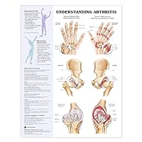 Understanding Arthritis Anatomical Chart Understanding Arthritis Anatomical Chart Wall Chart