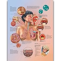 Respiratory Tract Infections Anatomy Posters for Walls Nursing Students Educational Anatomical Poster Chart Waterproof Canvas Medicine Disease Map for Doctor Enthusiasts Kid's Enlightenment Education (Respiratory Tract Infections, 20x30inches)