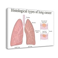 TSFTEC Smoking Addiction Lung Cancer Poster Poster for Lung Cancer Histological Guidelines(2) Canvas Painting Wall Art Poster for Bedroom Living Room Decor 08x12inch(20x30cm) Frame-style
