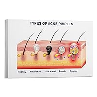 Beauty Salon Poster Acne Acne Poster Epidermal Dermis Structure Chart Poster Hospital Poster Canvas Poster Wall Art Decor Print Picture Paintings for Living Room Bedroom Decoration Frame-style 30x20in