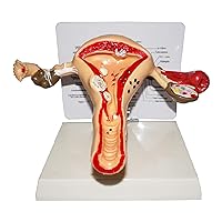 Gynecological Uterus Structure Anatomy Model, Human Pathological Uterus Model, Female Reproductive Organs Medical Lesion for Teaching Learning Tool